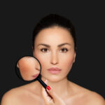 Melasma e acne: tratamento conjunto.