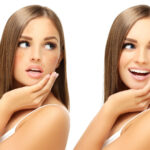 Melasma e peelings químicos.