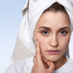 Acne e a escolha de produtos de limpeza facial