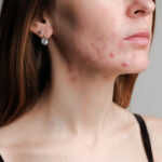 Acne Grau III