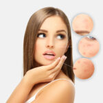 Como lidar com a desidratação da pele acneica