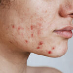 Diferenças entre a acne e a foliculite
