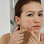 Tratamento de acne com terapias a laser de baixa potência