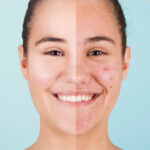 Tratamentos alternativos para acne resistente